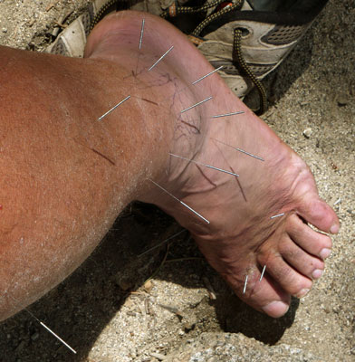 My Foot Acupunctured, June 10