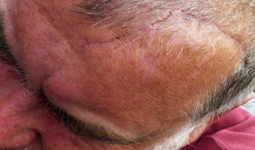 17cm Forehead Scar